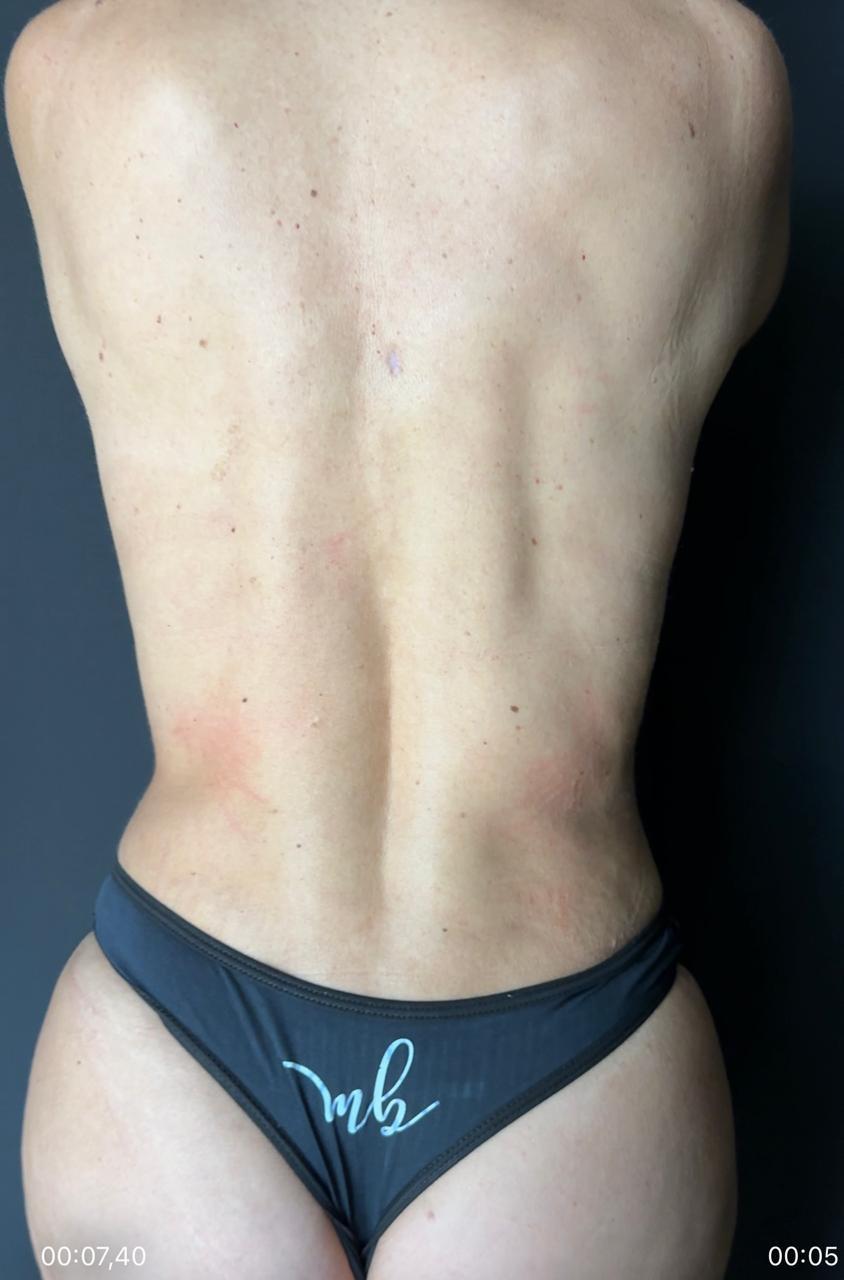 Vista posterior com definição de costas após lipoaspiração HD